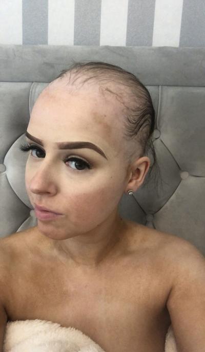Mise during treatment