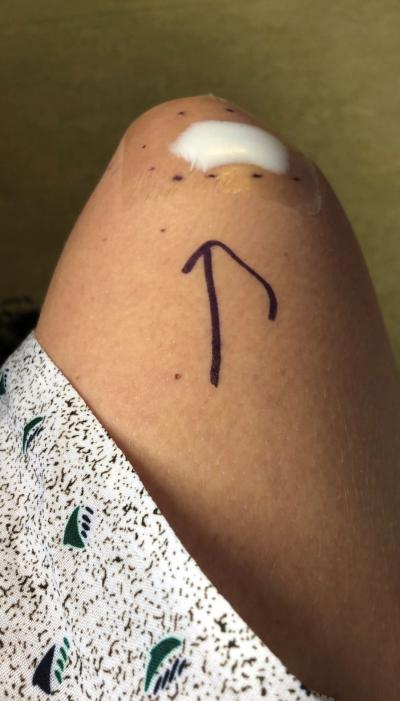 Laura's knee after a stage 3 melanoma mole biopsy 