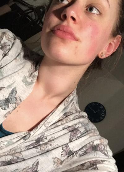 Natalie with swollen thyroid glands