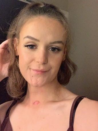 Rachel after treatment for tongue cancer