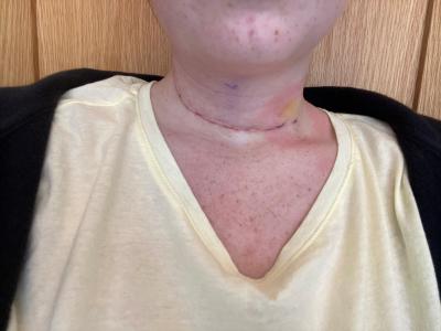Thyroid cancer surgery scar