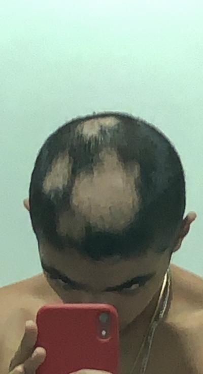 Amun's hair loss after treatment